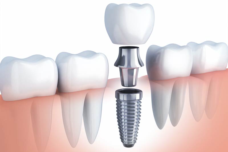 Implants Dentist in Camarillo